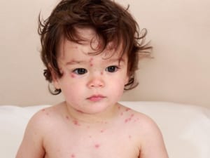 Thuỷ đậu do đâu mà ra? Các dấu hiệu, biến chứng và cách điều trị