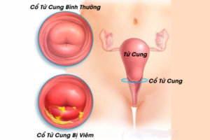 Nguyên nhân và cách phòng ngừa viêm cổ tử cung ở phụ nữ